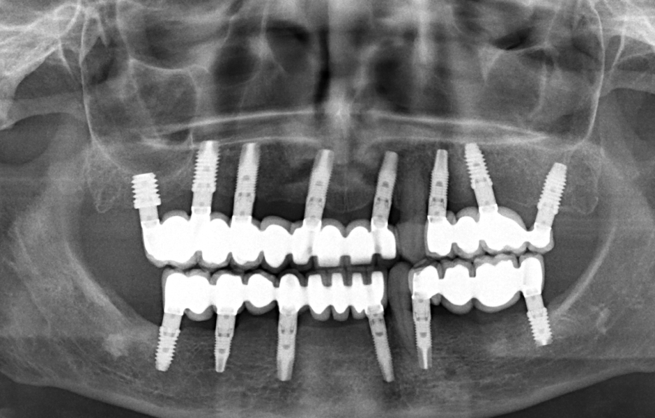 Obr. 21–22: OPG po sedmi letech od ukončení rekonstrukce: oba špičáky a všechny implantáty jsou stabilní.