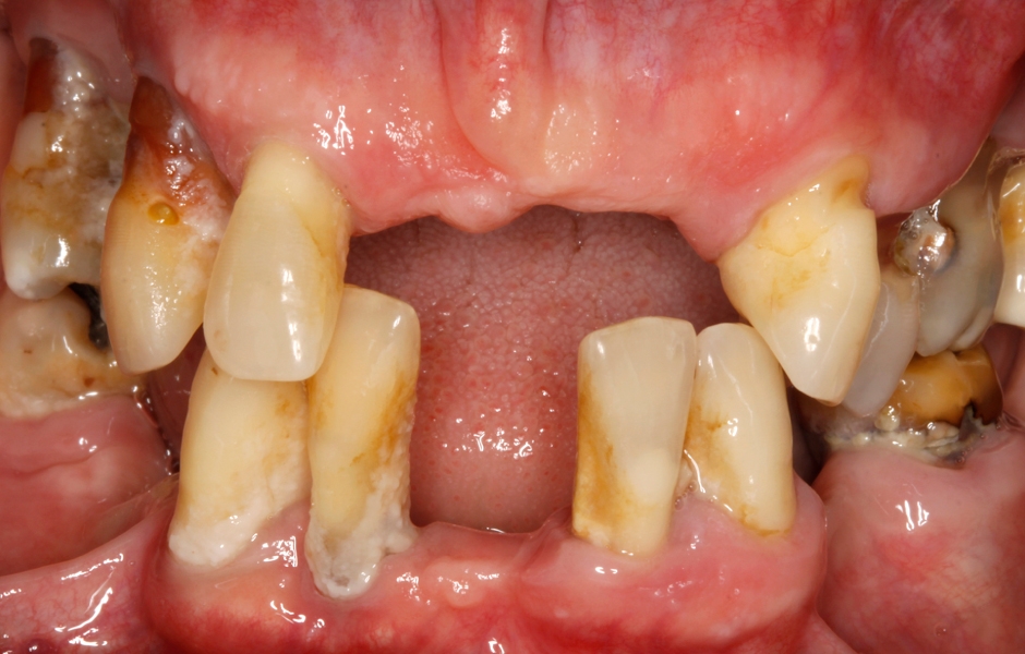Obr. 2–5: Úvodní fotodokumentace pacientky, na kterých je patrný špatný stav snímatelné náhrady, u zbývajících zubů vidíme ztrátu kosti, obnažené kořeny, nánosy zubního kamene a plaku.