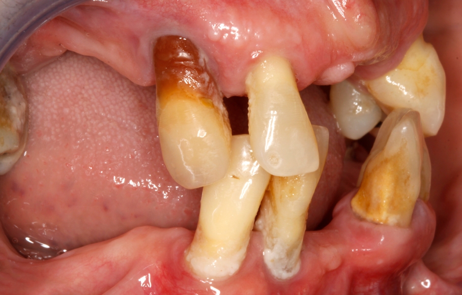 Obr. 2–5: Úvodní fotodokumentace pacientky, na kterých je patrný špatný stav snímatelné náhrady, u zbývajících zubů vidíme ztrátu kosti, obnažené kořeny, nánosy zubního kamene a plaku.