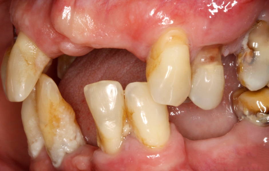 Obr. 2–5: Úvodní fotodokumentace pacientky, na kterých je patrný špatný stav snímatelné náhrady, u zbývajících zubů vidíme ztrátu kosti, obnažené kořeny, nánosy zubního kamene a plaku.