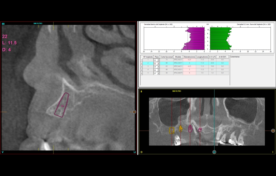 Obr. 6–7: CBCT snímky ukazují horizontální deficit kosti ve frontálním úseku – byly proto zvoleny úzké implantáty. Do horního pravého laterálního úseku byl kvůli malé výšce alveolu zaveden krátký implantát.