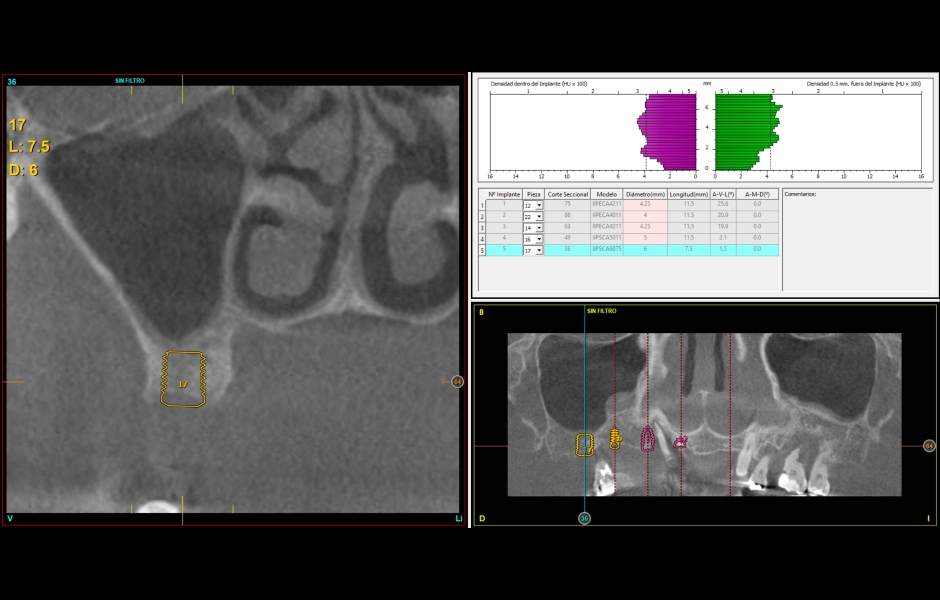 Obr. 6–7: CBCT snímky ukazují horizontální deficit kosti ve frontálním úseku – byly proto zvoleny úzké implantáty. Do horního pravého laterálního úseku byl kvůli malé výšce alveolu zaveden krátký implantát.