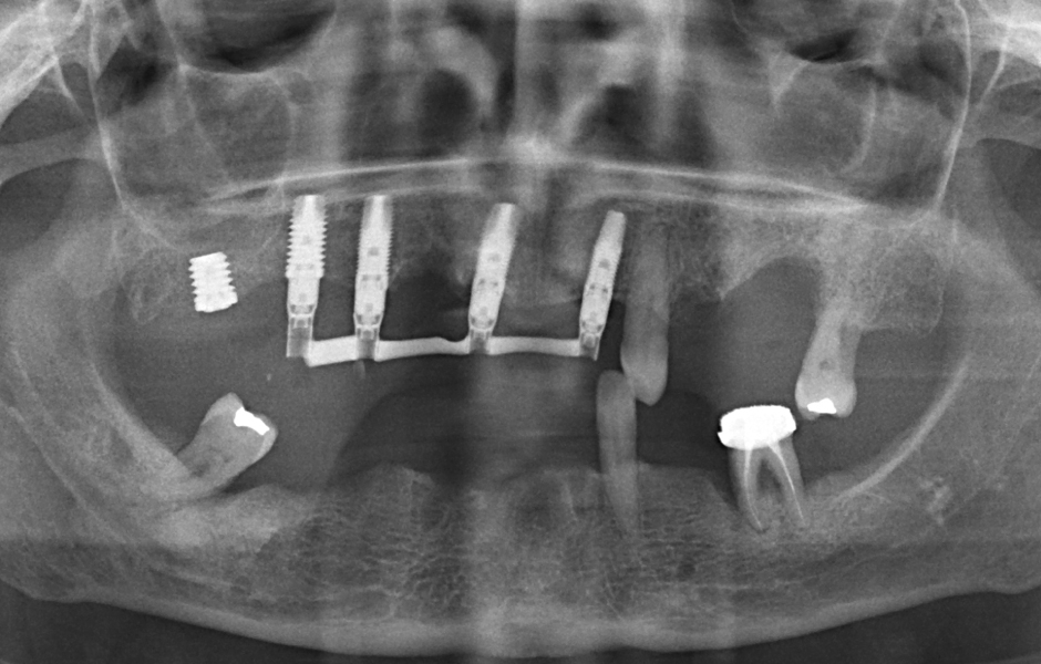 Obr. 8: OPG po zavedení frontálních a pravého laterálního implantátu v horní čelisti. Po 2–3 hodinách od inzerce byla nasazena imediátní náhrada s výztuží.