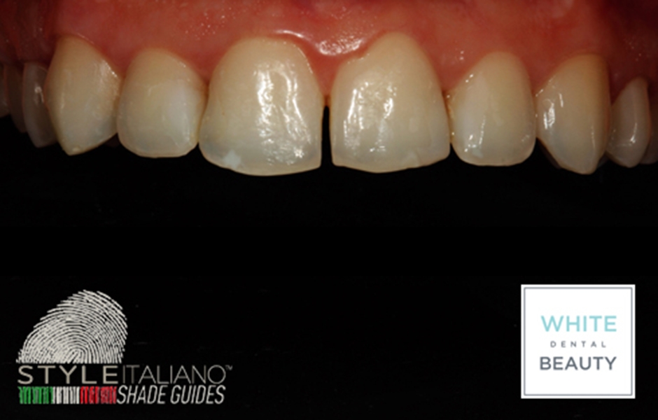 Pacient chtěl zkrášlit úsměv, konkrétně tvar zubů. Ještě před regeneračním zákrokem doporučila doktorka Anna Salat bělení zubů pro co nejlepší estetický výsledek.
