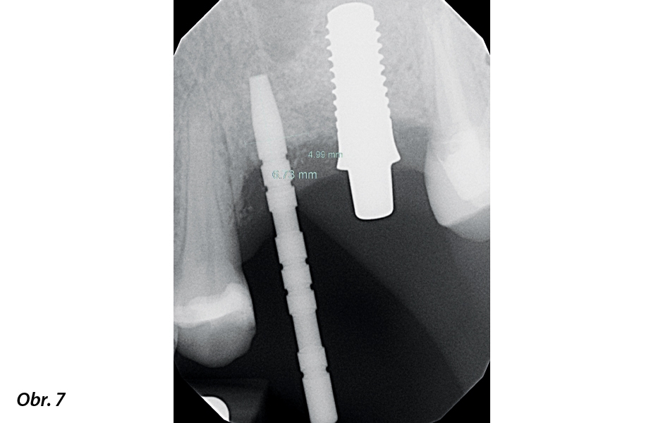 Do předběžné osteotomie meziálního implantátu byl vložen paralelizační pin a byl pořízen rentgenový snímek, aby se ověřil dostatek prostoru a trajektorie s implantátem umístěným do distálního místa.