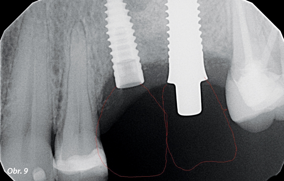 Rentgenový snímek pořízený bezprostředně po zavedení implantátu k ověření polohy implantátu ve vztahu k hřebenu, sousedním zubům a sousednímu implantátu.
