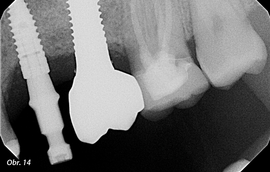Do implantátu byl připevněn otiskovací pin pro techniku otevřeného otiskování a byl zhotoven rentgenový snímek pro ověření úplného spojení mezi otiskovacím pinem a implantáty.