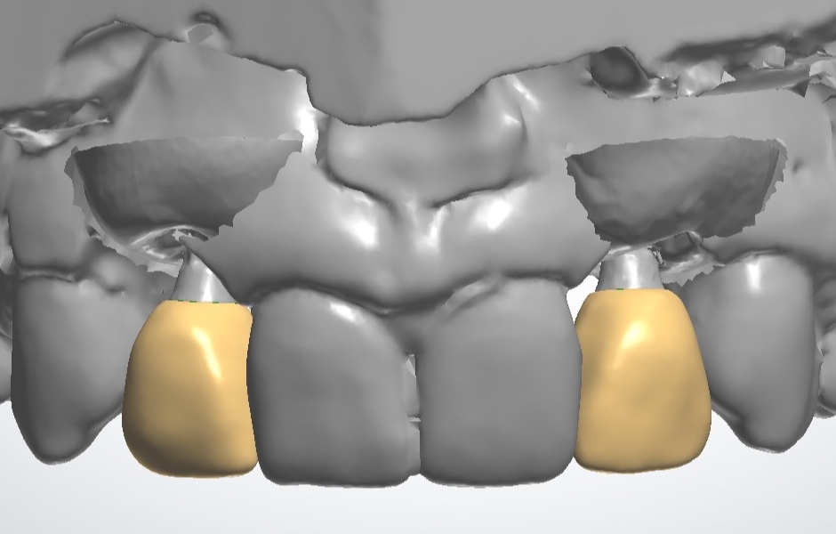 Obr. 15 a 16: Digitální modely jsou vytvořeny skenováním sádrového modelu se skenovacími tělísky – digitální plánování dočasných náhrad pomocí 3Shape softwaru.