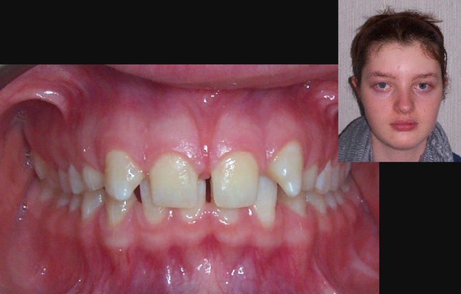 Obr. 1 a 2: Celkový pohled na obličej pacientky a pohled před ortodontickou léčbou.