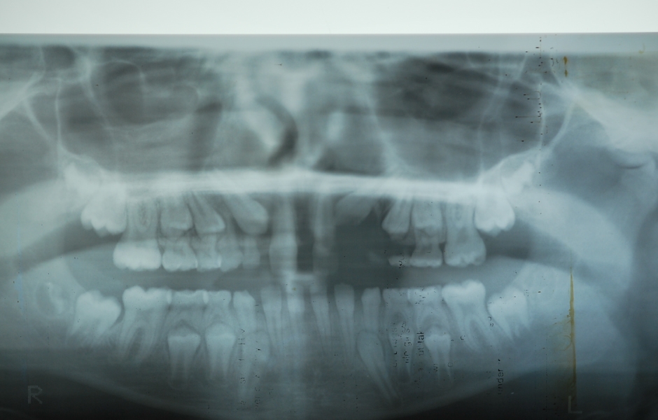Obr. 3: Panoramatický snímek, smíšená a stálá dentice.