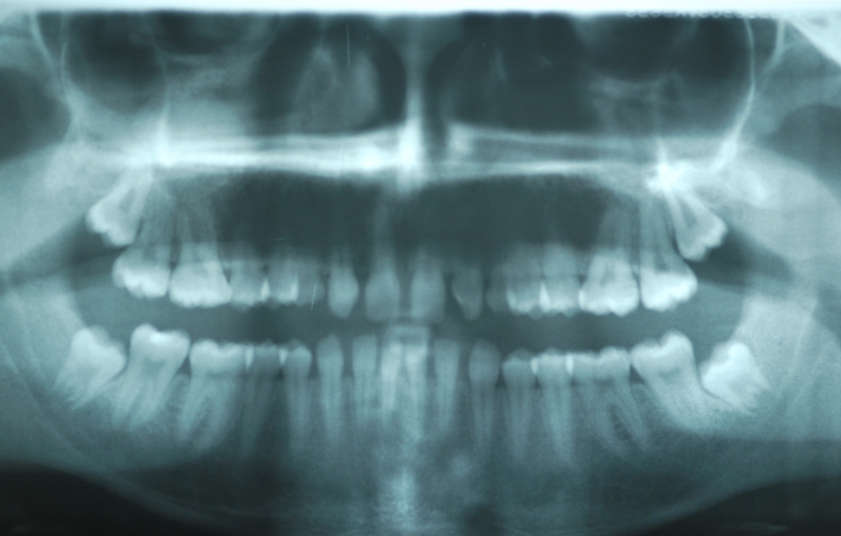 Obr. 4: Panoramatický snímek, smíšená a stálá dentice.