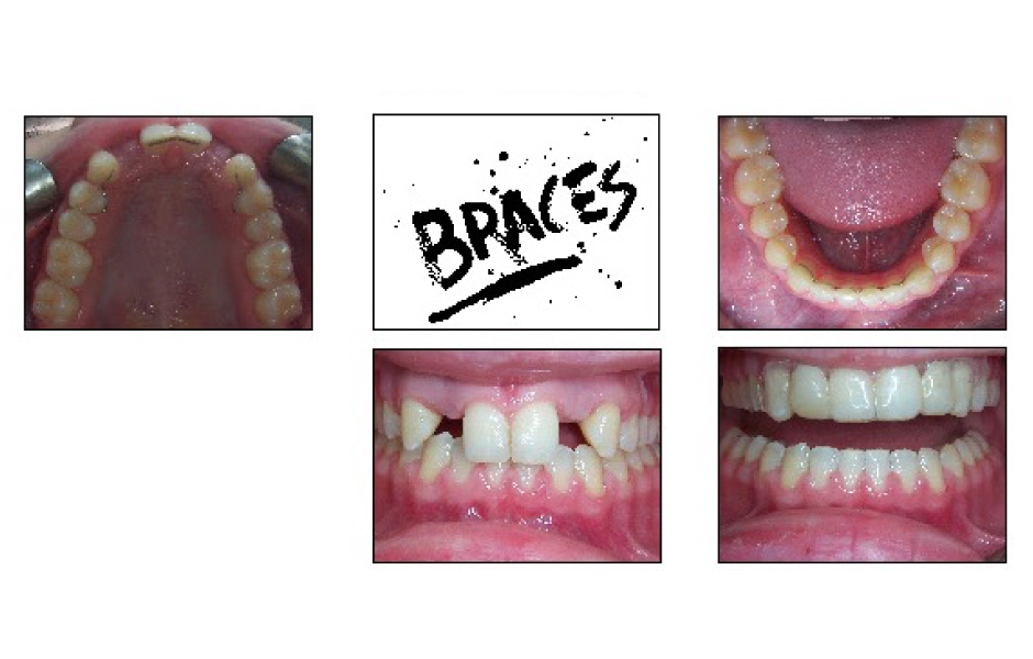 Obr. 5: Léčba fixními retainery po ortodontické léčbě.