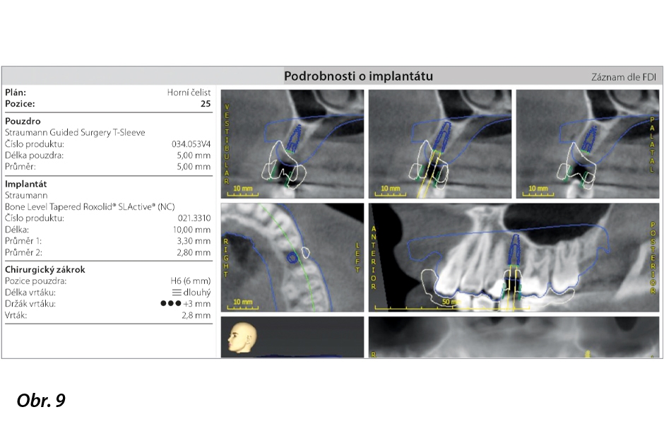 Prověřený digitální pracovní postup  se systémem Straumann CARES Digital Solutions a coDiagnostiX