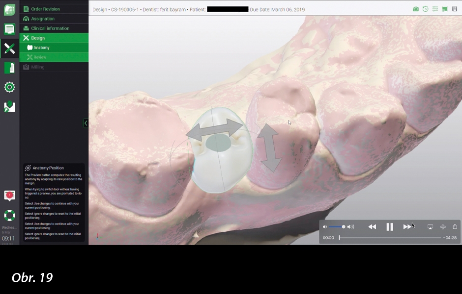 Prověřený digitální pracovní postup  se systémem Straumann CARES Digital Solutions a coDiagnostiX