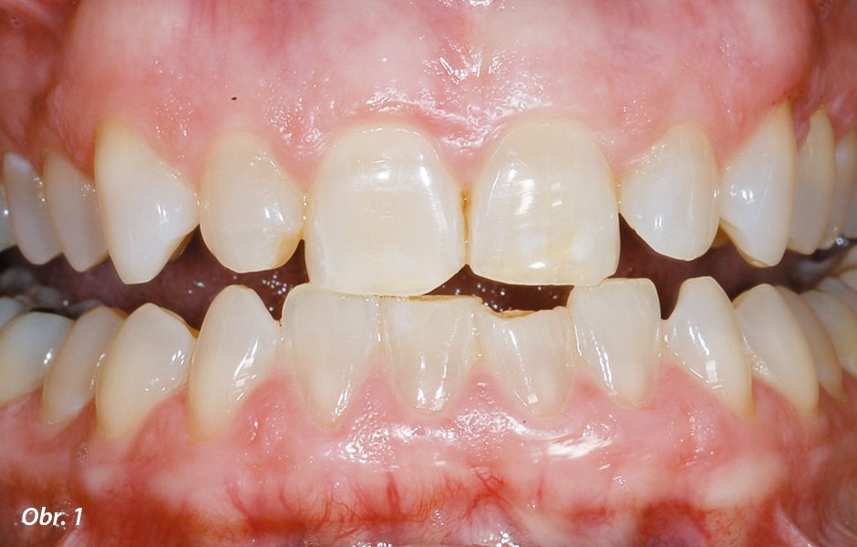 Zuby diskolorované tetracyklinem před bělením přes noc 10% karbamid peroxidem v nosiči bez vroubkování a rezervoáru