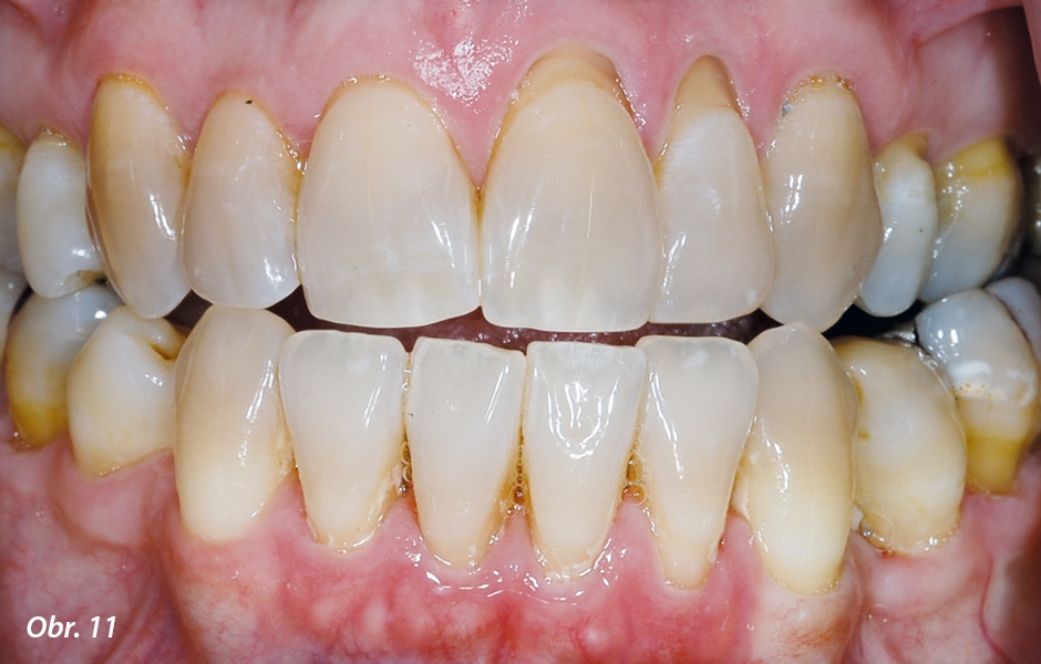 Tetracyklinem mírně diskolorované zuby s obnaženými povrchy kořene vyžadují informování pacienta o prognóze obnažených kořenů