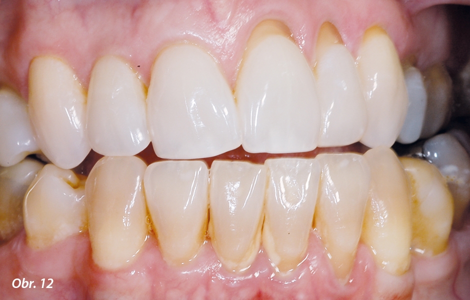 Šest měsíců nočního bělení 10% karbamid peroxidem zuby zesvětlilo, ale povrchy kořene zůstaly diskolorované