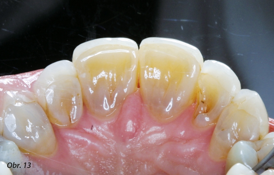 Na zuby diskolorované tetracyklinem byly před bělením umístěny keramické fazety, což často vyžaduje fazety opaknějšího odstínu