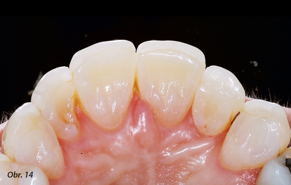 Bělení přes noc 10% karbamid peroxidem po dobu 4 měsíců zuby zesvětlí, což může znatelně změnit odstín fazet, nejsou-li dostatečně opakní