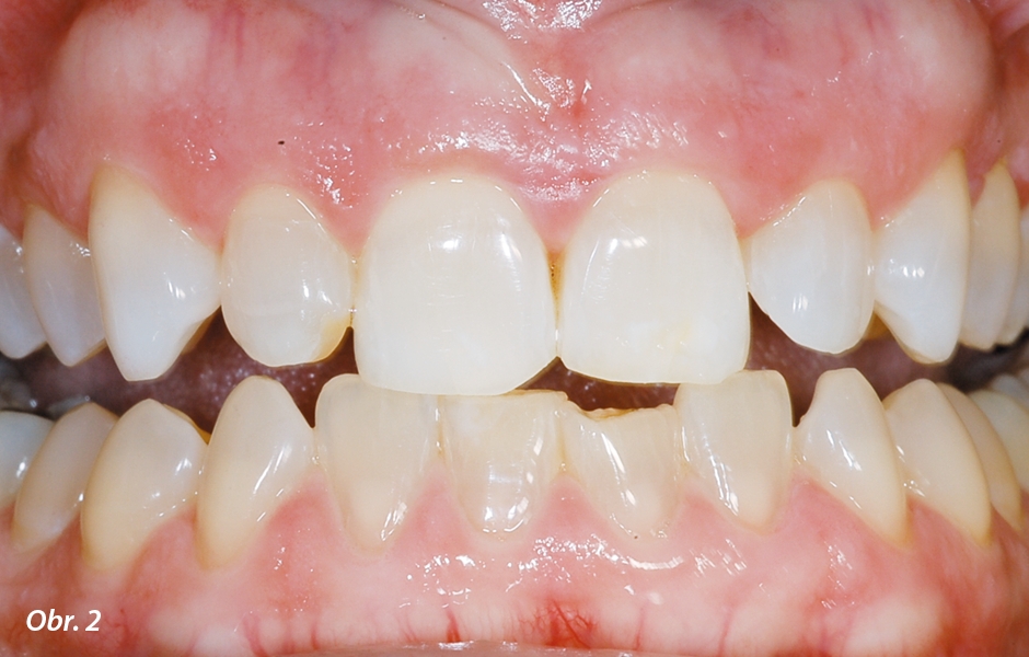 Bělení jednoho oblouku přes noc po dobu 3 až 4 měsíců 10% karbamid peroxidem vykazuje zlepšení, ale ne tak podstatné, jako by tomu bylo u normálních zubů