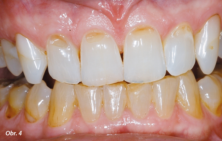 Po bělení 10% karbamid peroxidem, zuby jsou světlejší, ale ne bílé