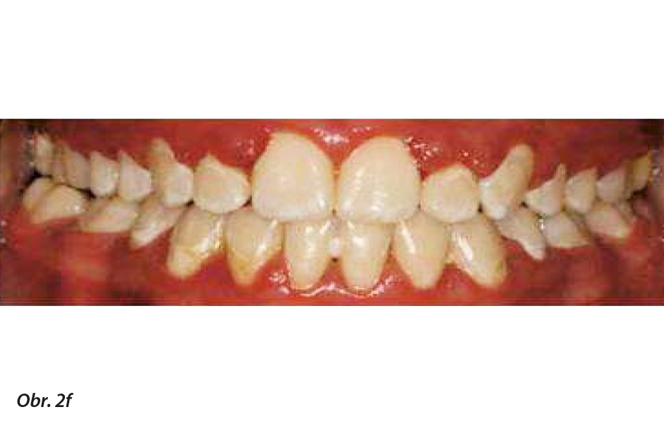 Ortodontické bílé léze