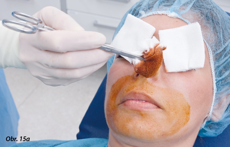Periorální kůže se otírá kruhovými pohyby za použití roztoku jodového povidonu, počínaje rty. Je třeba chránit oči pacienta gázou nebo maskou.