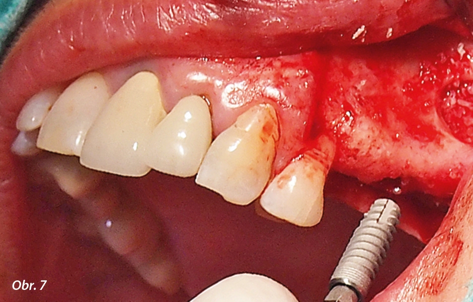 Zavedení GC Aadva Standard implantátu o rozměrech 3,3 × 12 mm do premolárové oblasti