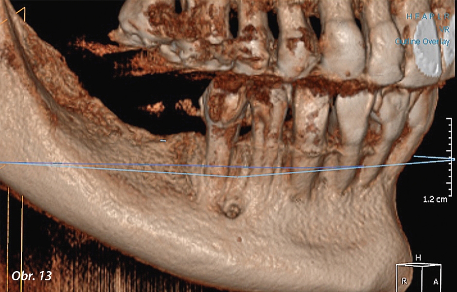 CBCT snímek bezzubého úseku dolní čelisti