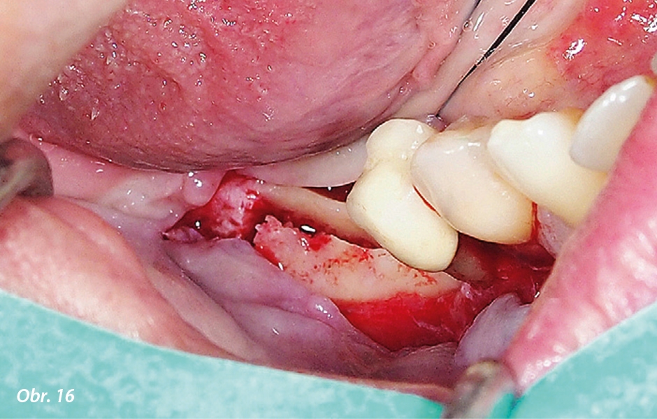 Splitting alveolární kosti a lalok s uvolňovacími nářezy