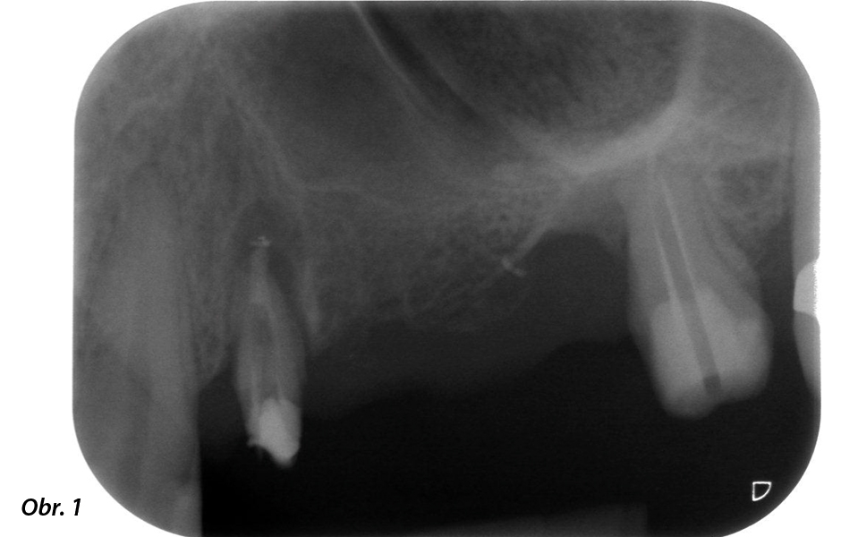 58letá pacientka: předoperační RTG snímek zachycující apikální periodontální lézi u zubu 24 a horizontální úbytek alveolární kosti v druhém kvadrantu.