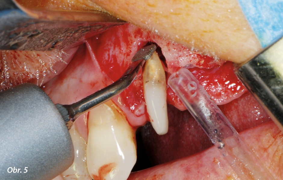 … a bukální apex zubu 24 byl abradován tím samým nástrojem (apikoektomie).