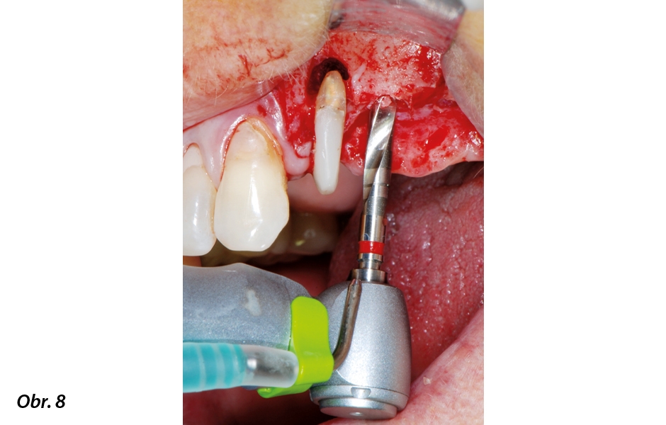 Rotační preparace lůžka pro implantát blízko dna maxilárního sinu v oblasti zubu 25, provedená pomocí nejnovějšího implantologického mikromotoru.