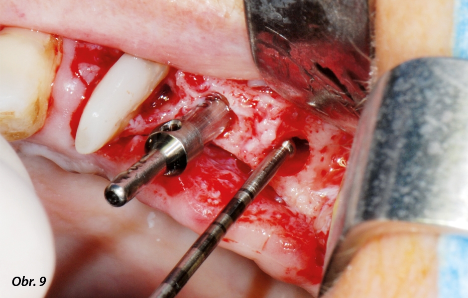 Po preparaci lůžka pro implantát v oblasti zubu 26 byla pomocí parodontologické CPITN sondy s kulatým hrotem zkontrolována celistvost membrány sinu.
