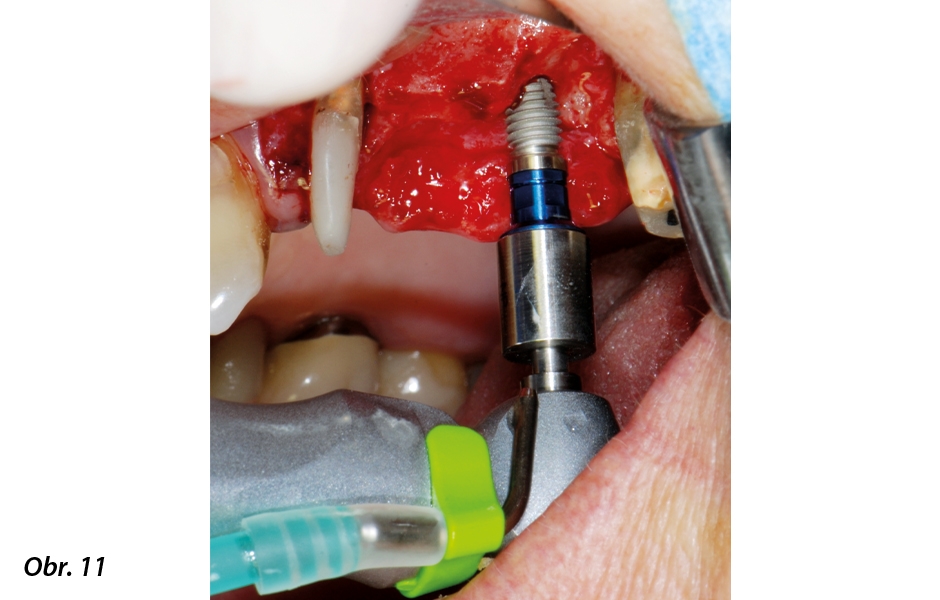 Zavádění implantátu v oblasti zubu 26 za nízké rychlosti s omezením točivého momentu na 35 Ncm.