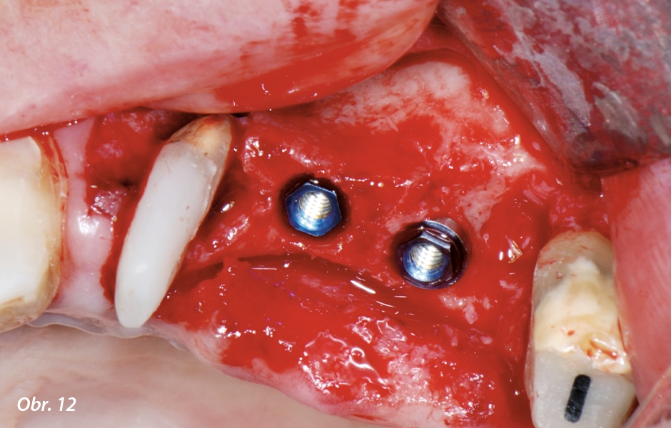 Oba zavedené implantáty připravené na umístění krycích šroubků.