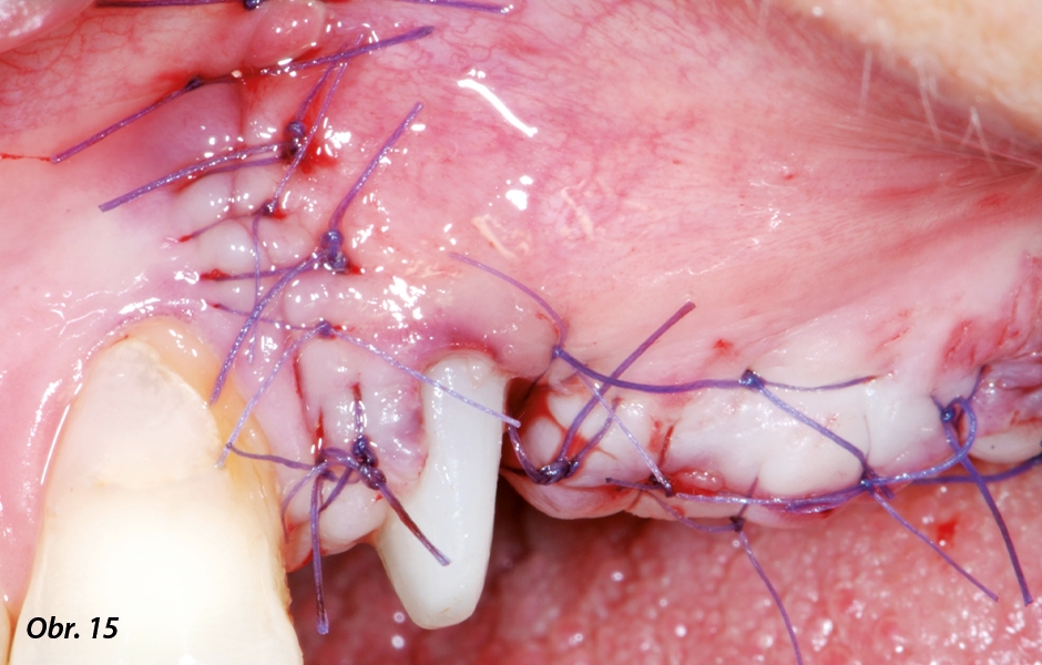 Oblast chirurgického zákroku po volném sešití vstřebatelným materiálem – po šesti měsících budou implantáty opět obnaženy za účelem otiskování.