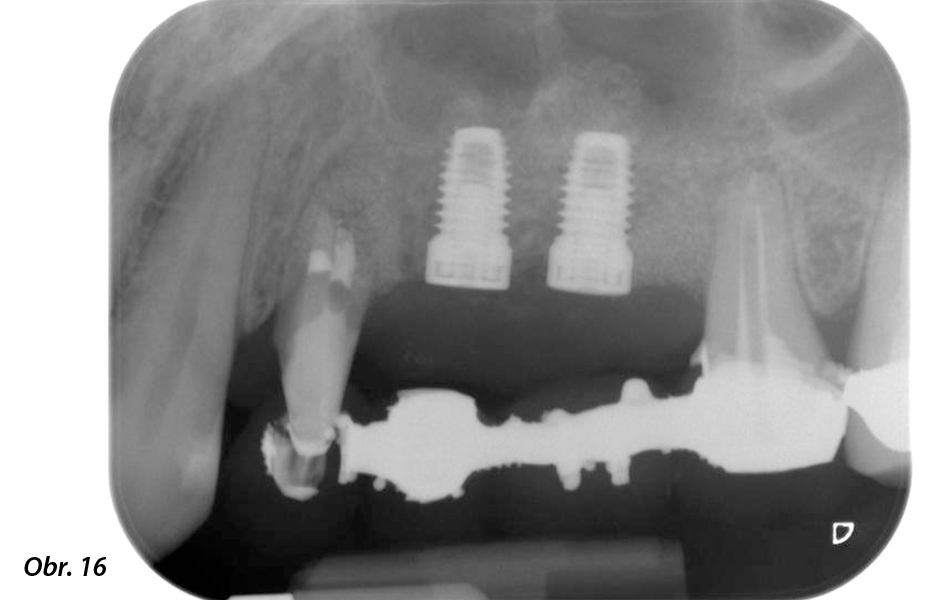 Pooperační RTG snímek zachycující zavedené implantáty s kostní náhradou transplantovanou kolem apexů při vnitřním sinus liftu – kolem kořenů zubu 24 je vidět i materiál z GTR procedury.