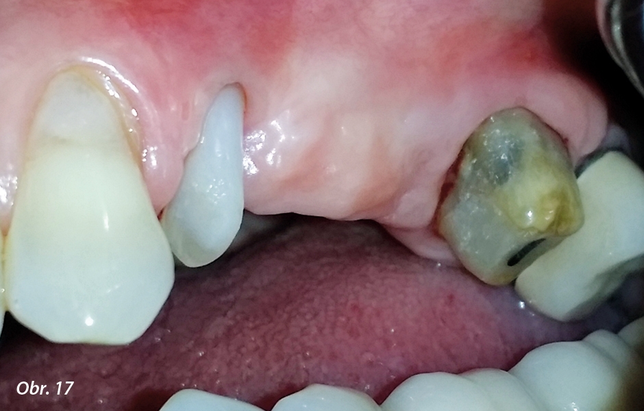 Dva měsíce po chirurgickém zákroku byla pacientka bez bolesti a oblast bez zánětu – zub 24 v té době také vykazoval menší mobilitu.