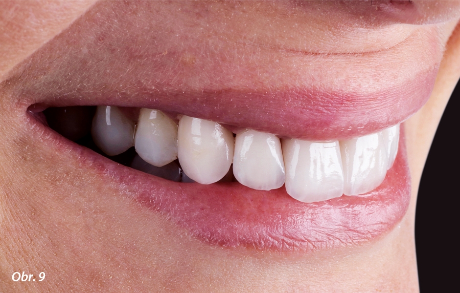 Zubní oblouk byl vytvarován podle pravidel estetiky přirozeného chrupu.