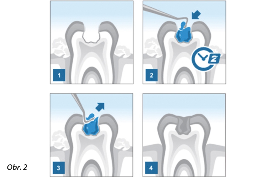 1. Zubný kaz I. Bl. triedy, 2. Aplikácia gélu BRIX3000® po dobu 2 minút, 3. Exkavácia infi kovaného dentínu, 4. Kavita po ošetrení