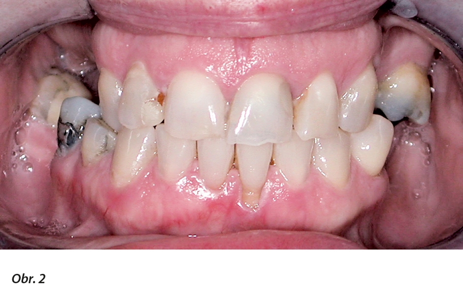 Tento chrup má pouze jeden pár okludujících premolárů. To otevírá protetickou volbu mezi rehabilitací pomocí horní a dolní ČSN a koncepcí zkráceného zubního oblouku s náhradou chybějících tří párů premolárů.
