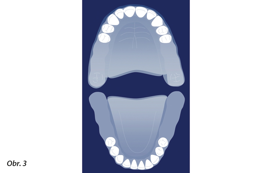 Zde je naznačena situace zkráceného zubního oblouku s 10 horními a 10 dolními zuby a distální okluzí tvořenou čtyřmi páry protějších premolárů