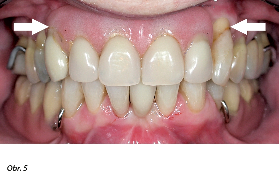 Pečlivě konstruovaný a probarvený okraj pryskyřičné ČSN může doplnit chybějící objem alveolárního hřebenu. Umožňuje také přizpůsobit a harmonicky začlenit umělé zuby ČSN do zbývajícího přirozeného chrupu.