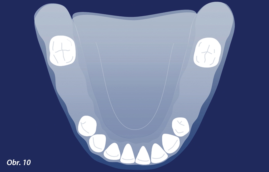 Kennedyho klasifikace III. třídy s potenciální strategickou plošnou oporou pro ČSN o přirozené zuby poskytovanou dvěma moláry a dvěma prvními premoláry