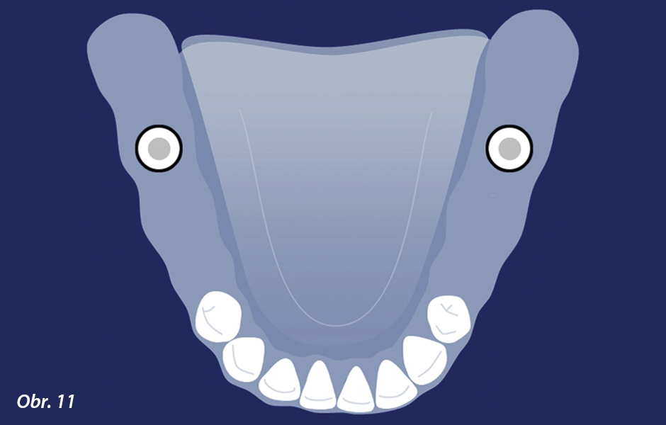 Kennedyho klasifikace I. třídy s oboustranně zkráceným zubním obloukem, kde byl v oblasti každého moláru zaveden implantát, aby bylo dosaženo strategických výhod konfigurace III. třídy