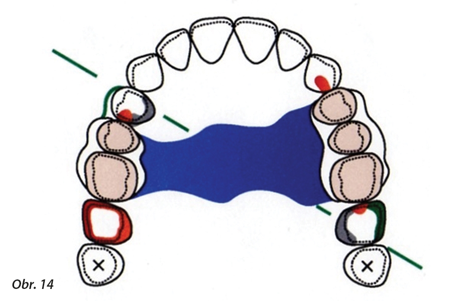 Příklad ČSN pro situaci Kennedyho III. třídy. Stabilizační prvky ČSN jsou umístěny distálně (červeně). Retenční prvky (zeleně) jsou naplánovány pro horní pravý premolár a horní levý molár.