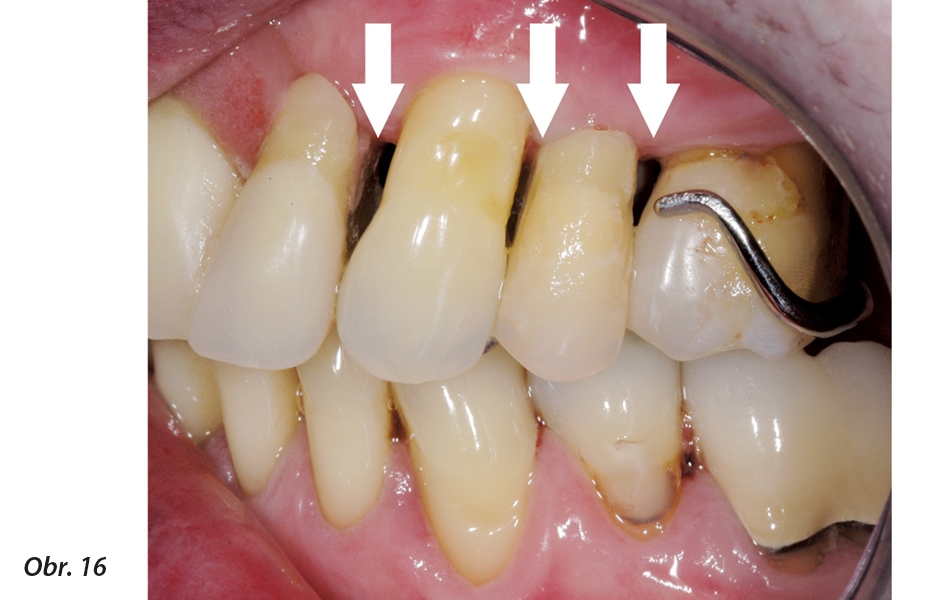 Zuby v náhradě z obou stran přirozeného horního levého špičáku jsou vytvarovány tak, aby byly zachovány čistitelné mezizubní prostory