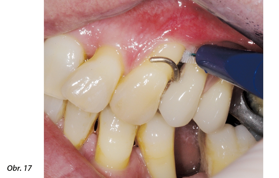Aproximální prostor nad bodem kontaktu mezi přirozeným pilířem a prvním zubem náhrady umožňuje zasunutí mezizubního kartáčku. To pomůže účinnému vyčištění distální strany přirozeného zubu.