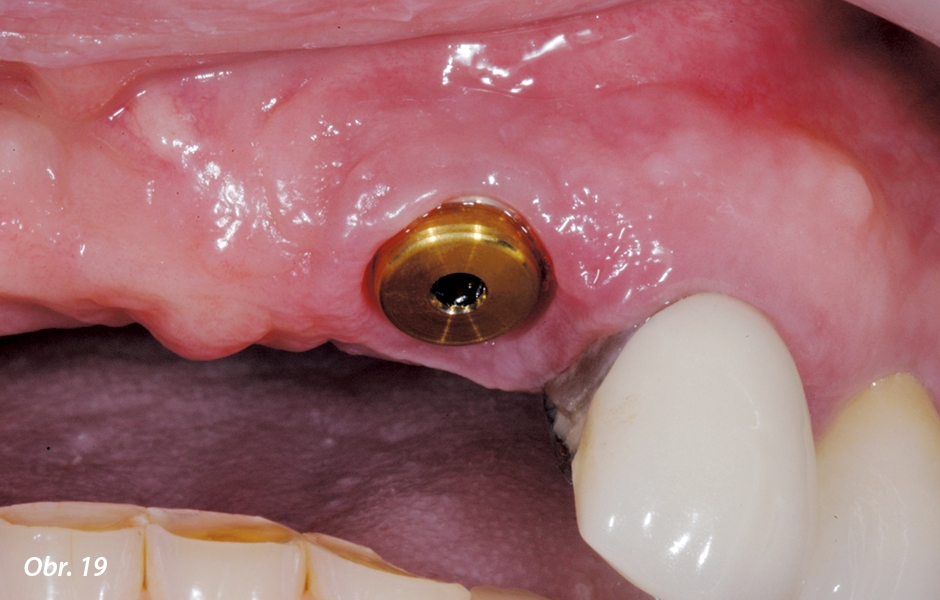 Strategicky umístěný implantát nahrazující horní levý postranní řezák opatřený abutmentem s prvkem pro magnetický attachment